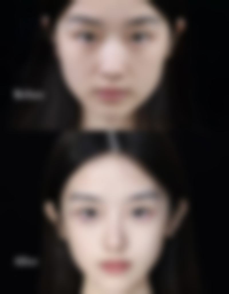二、大腿吸脂后要注意的休息要点