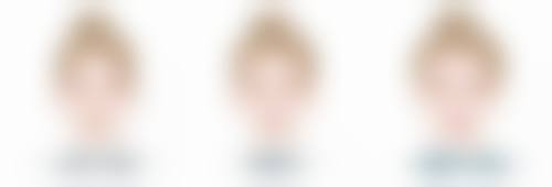 一、埋线双眼皮手术简介