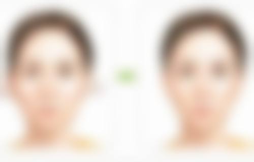 一、长脸割双眼皮需考虑的因素
