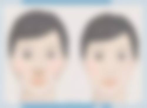 四、肋骨隆鼻的术后护理