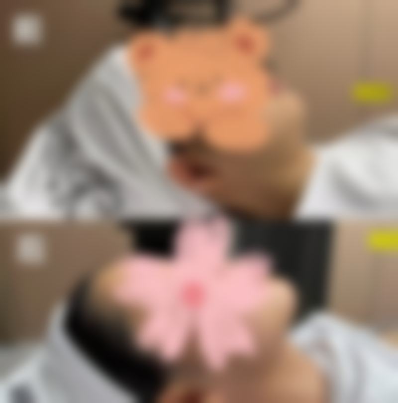 三、埋线双眼皮的优点