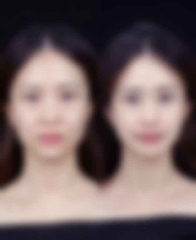 一、双眼皮手术的常见方式及特点