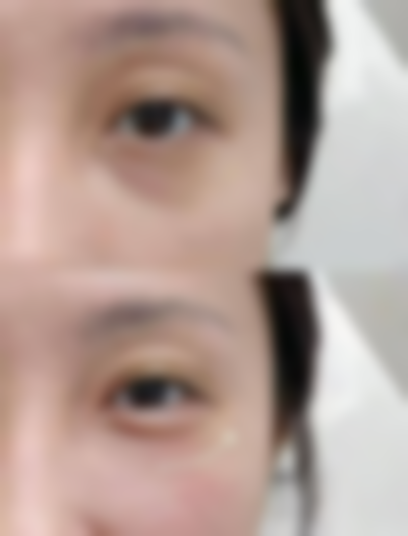 埋线双眼皮有创口吗？不满意拆了能否恢复原样，这里为你揭秘！ 