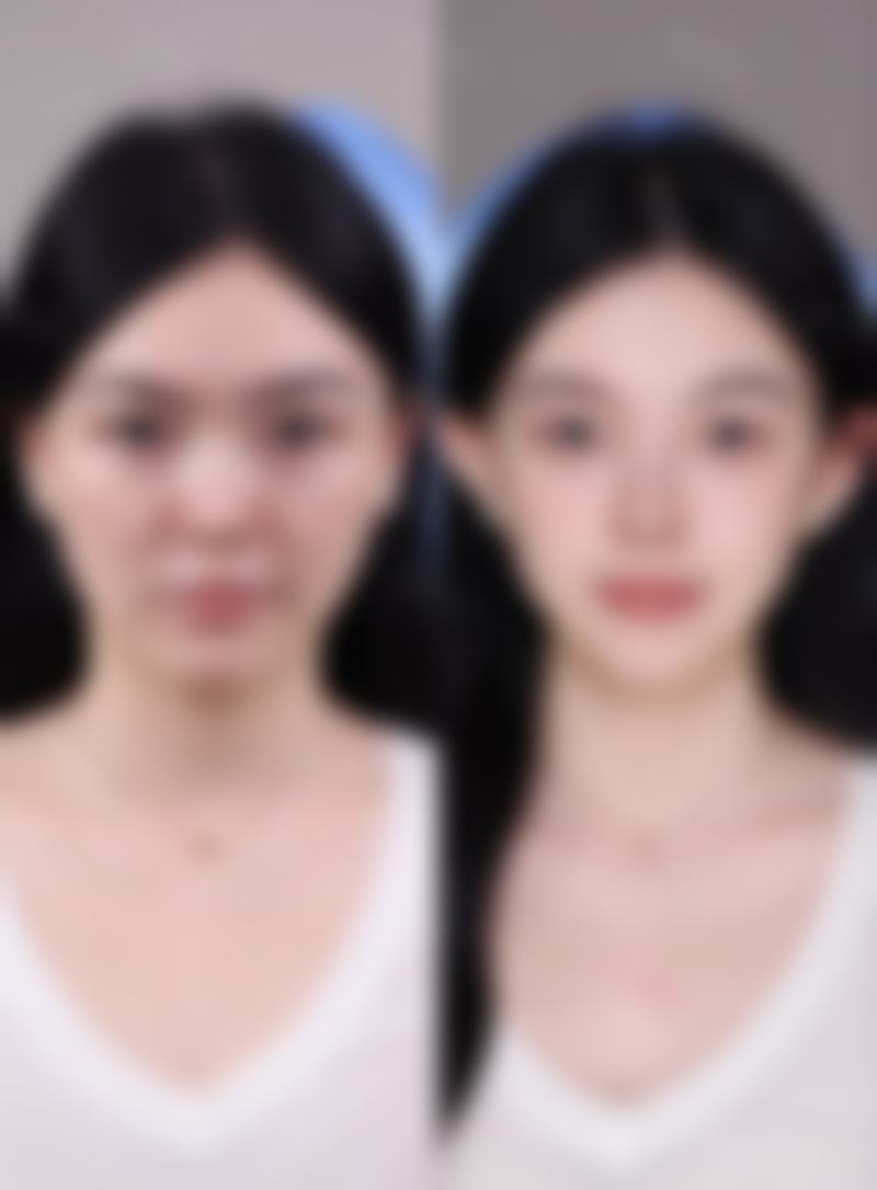 脸上烧伤的疤痕如何去掉？药物、光电、手术治疗方法及对应图片解析 