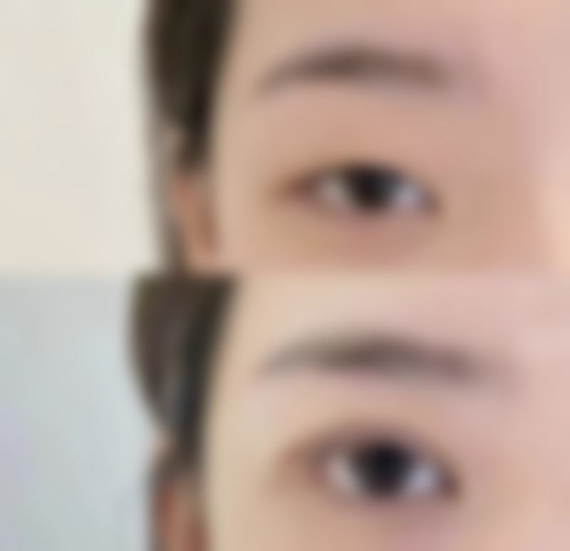 一、埋线双眼皮有创口吗