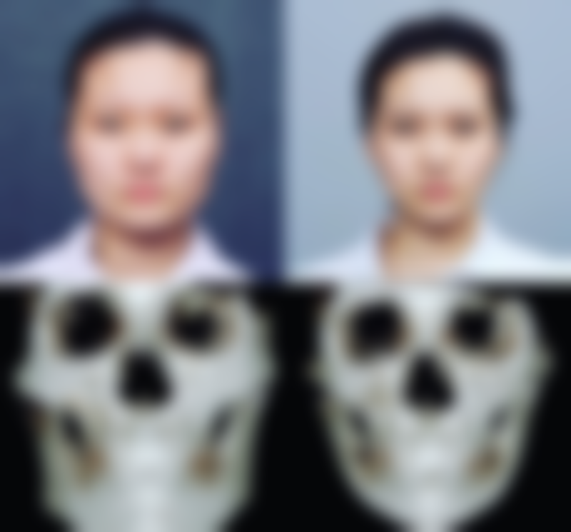 一、自体隆鼻肋骨疼不疼