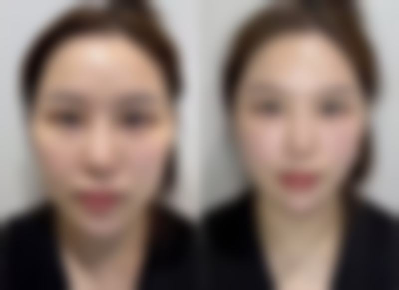 五、脸上烧伤的疤痕如何去掉之日常护理