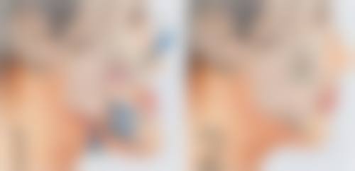 一、肋软骨隆鼻手术是咋回事