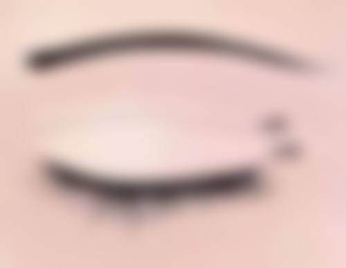 一、手术治疗:怎么去眼袋又快又好的快速之选