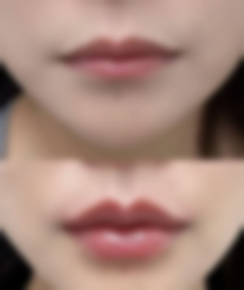 一、认识缝合的疤痕类型