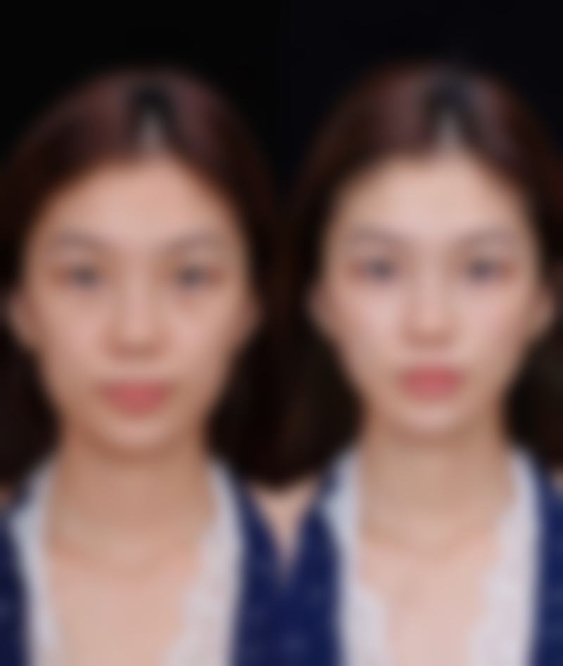 一、孩子眼袋大的原因分析