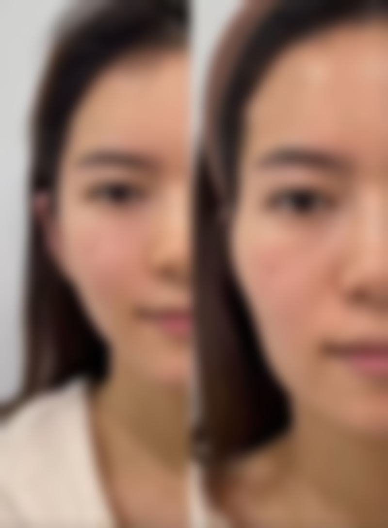 三、如何降低隆鼻坏处的发生