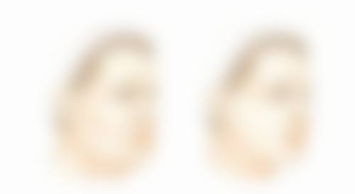 三、隆鼻术后修复过程