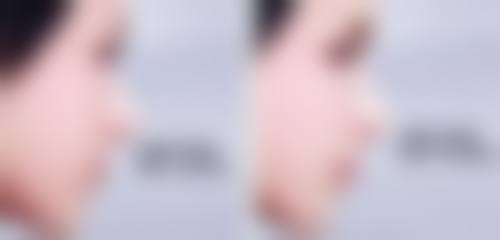 一、隆鼻修复自然的一般时间
