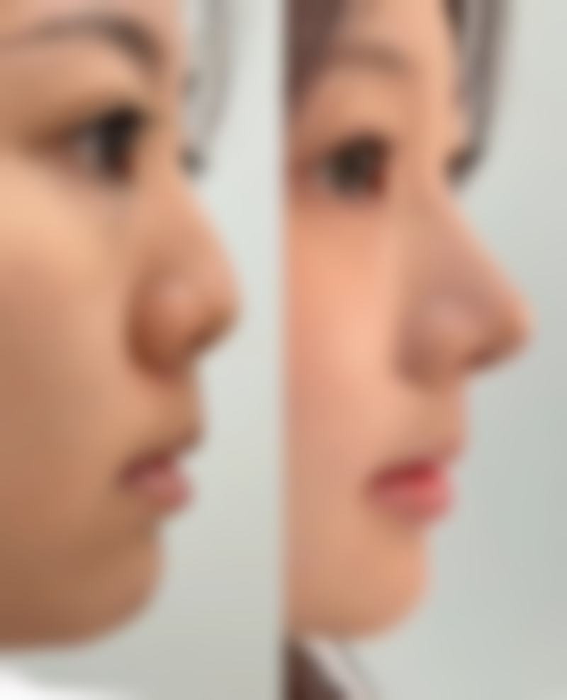 四、影响隆鼻修复自然时间的因素