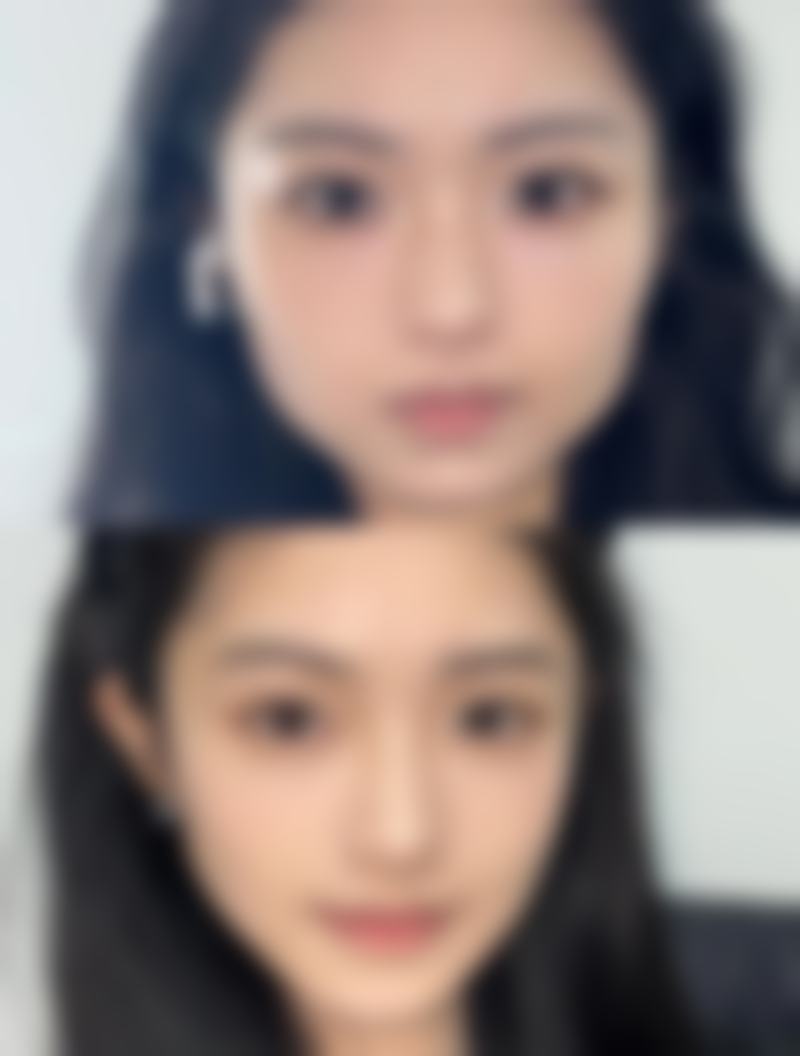 五、女生植发的特殊注意事项