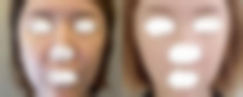 五、隆鼻术后护理要点