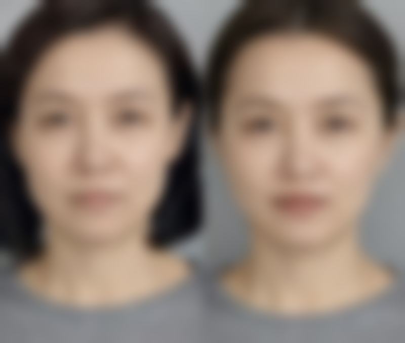 一、做假体隆胸对生孩子有影响吗？手术原理决定答案