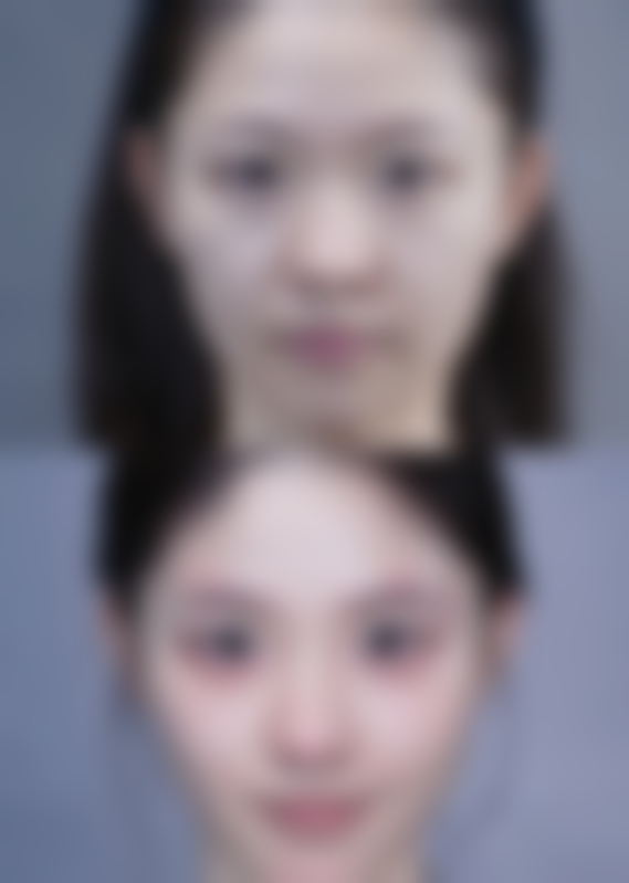 二、做假体隆胸对生孩子有影响吗？怀孕阶段的情况