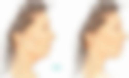 五、37岁打瘦脸针的成效维持和后续处理