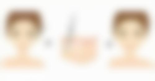 五、隆鼻多久后可以重做之术后护理