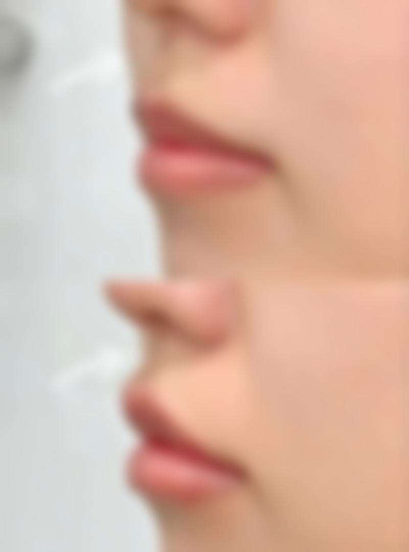 七、结尾:去眼袋有风险吗、会反弹吗?