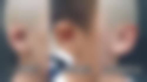 一、全切双眼皮和开眼角手术概述