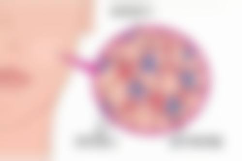 四、凸起疤痕如何祛除之物理治疗