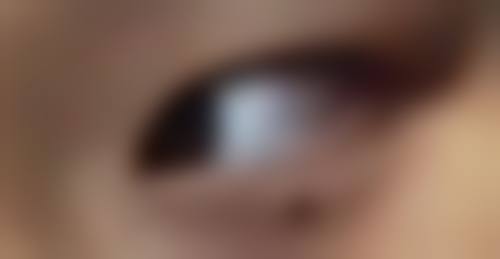 三、烫的疤痕去除费用知多少