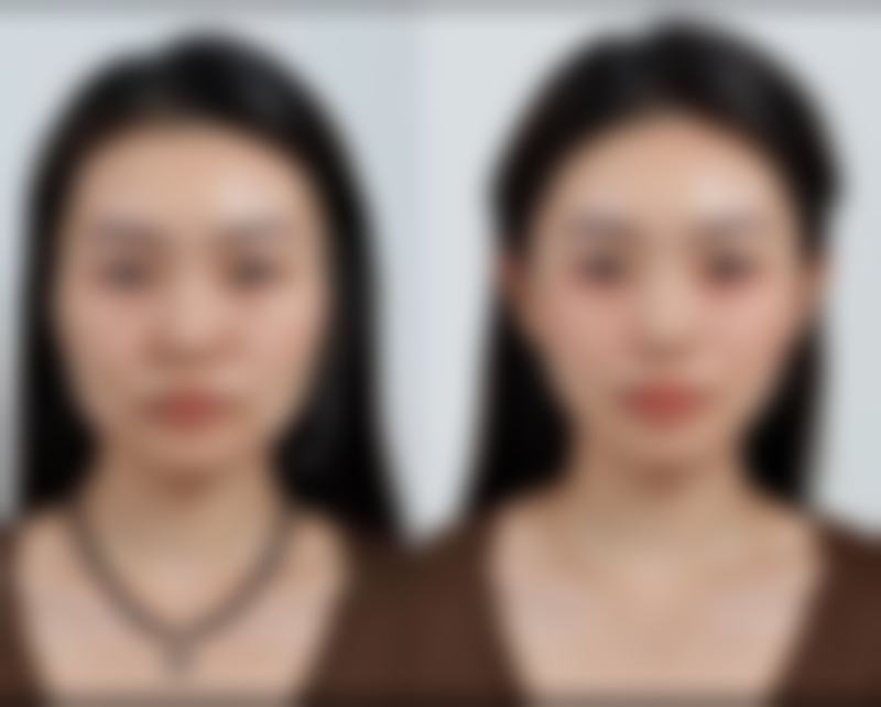 吸脂手术会反弹吗？揭秘术后保持效果不反弹的实用方法！ 