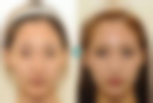 九、韩国1mm(一毫米)整形外科真实的患者评价