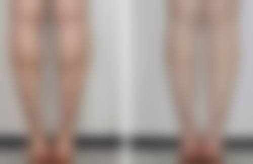一、全身抽脂适用人群