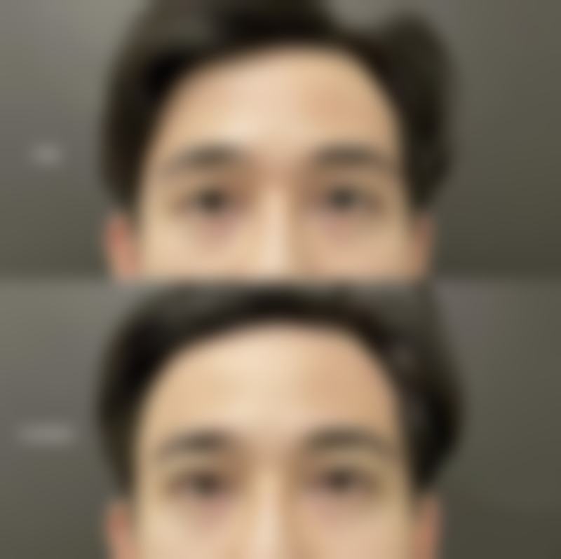一、瘦脸针一般多久打一次比较好之注射频率的影响因素