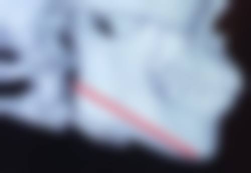 一、假体隆胸手术概述