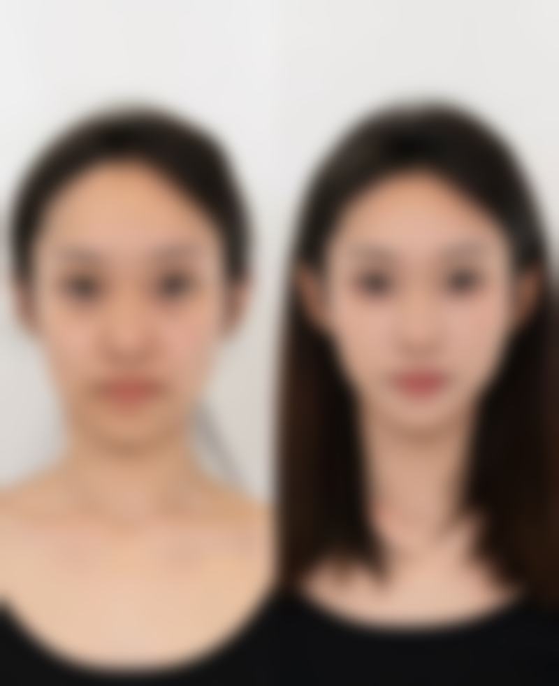 五、不同眼部状况的内双适合的手术方式