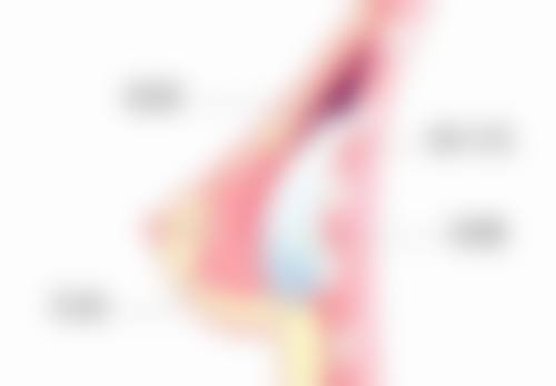 五、硅橡胶隆鼻出现问题的处理方法