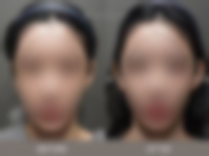 一、硅胶隆鼻十年后取出是否塌陷