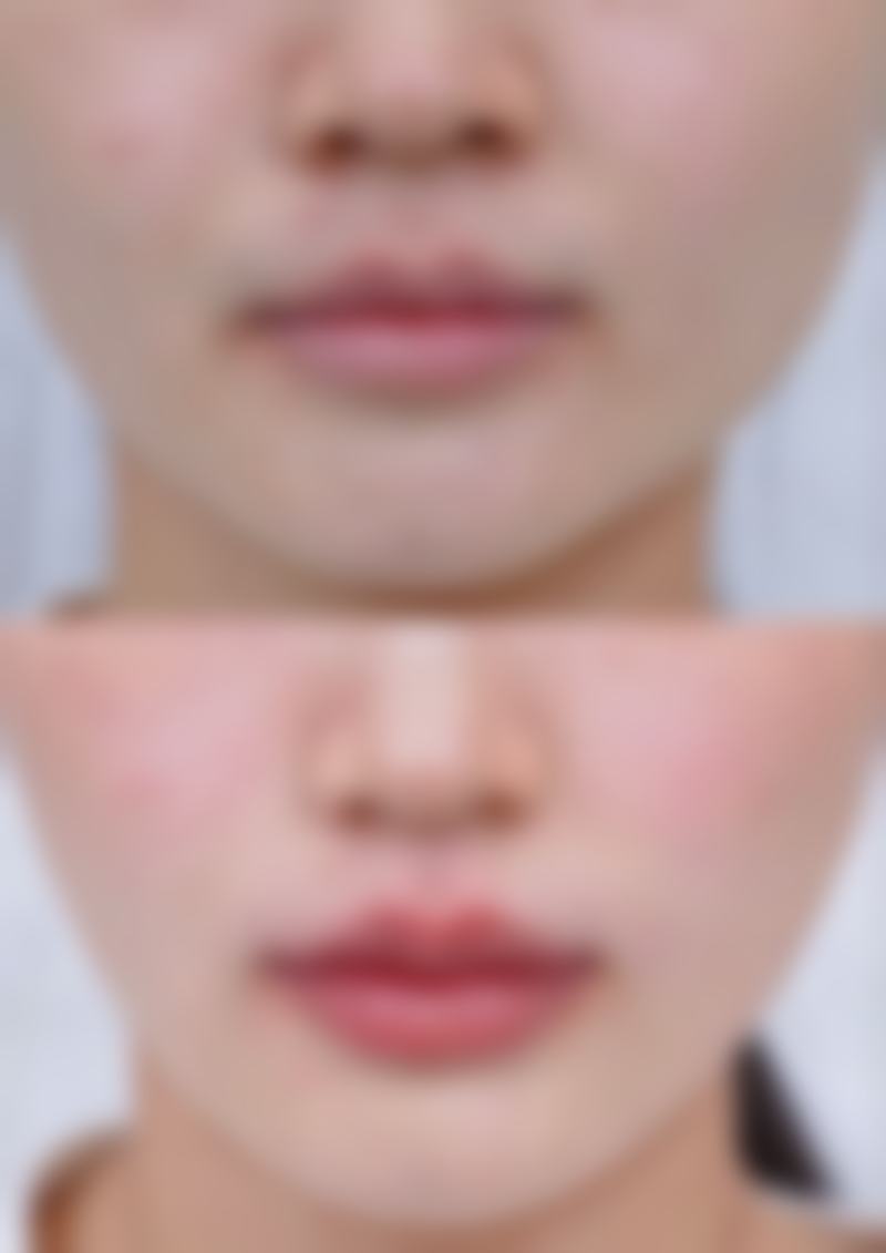 二、眼袋汗管瘤的去除方法
