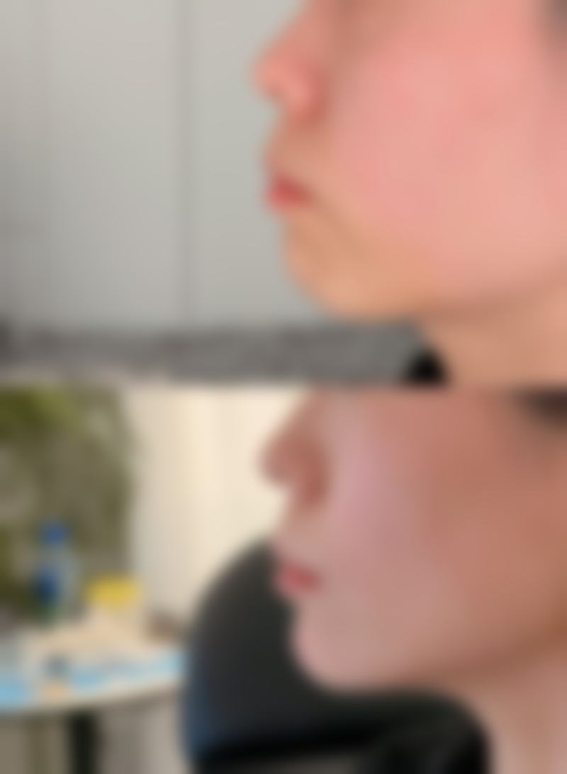 一、腹部吸脂塑身的成效
