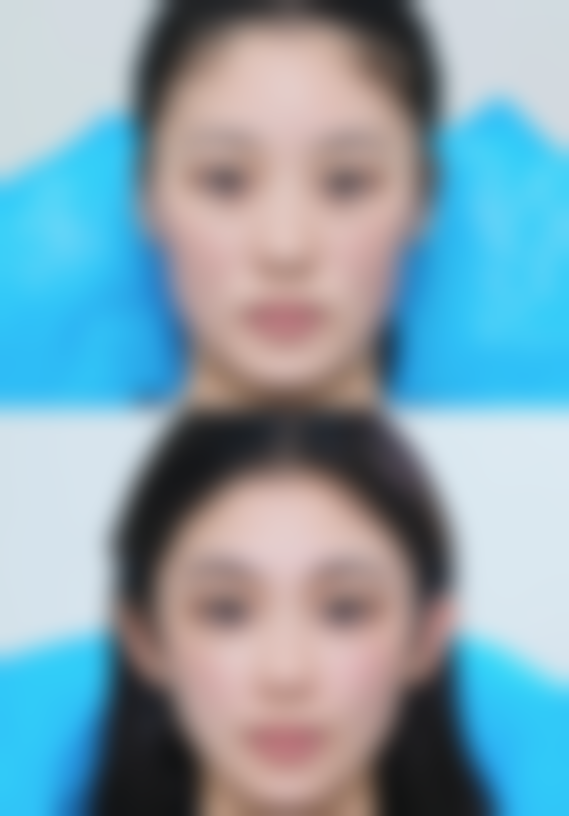 三、眼袋八字纹的激光治疗方法
