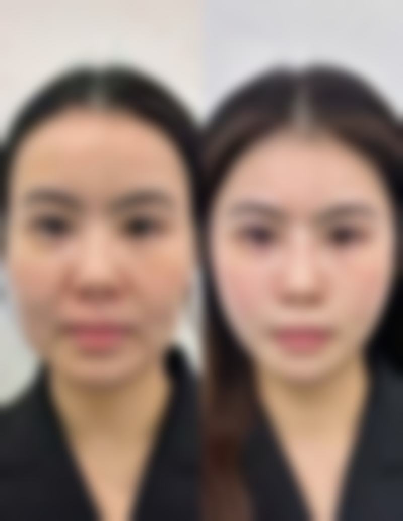 六、真人实例展示无痕祛眼袋成效
