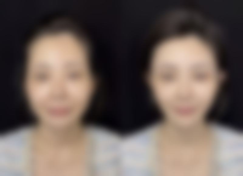 五、怎么样才能有效消除眼袋之手术治疗
