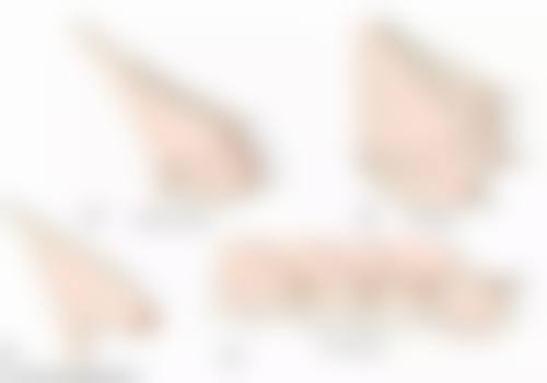 隆胸手术要多久时间？受手术方式等因素影响，一般需 1 - 3 小时！ 