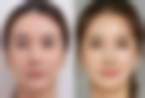 六、类蛇毒肽能去眼袋吗？综合总结