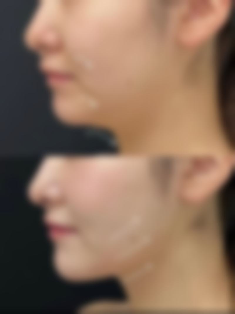 四、内双开双眼皮的风险