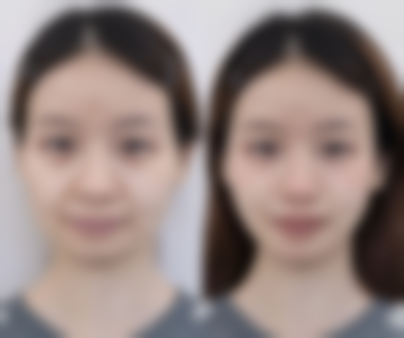 二、大腿抽脂后消肿时间