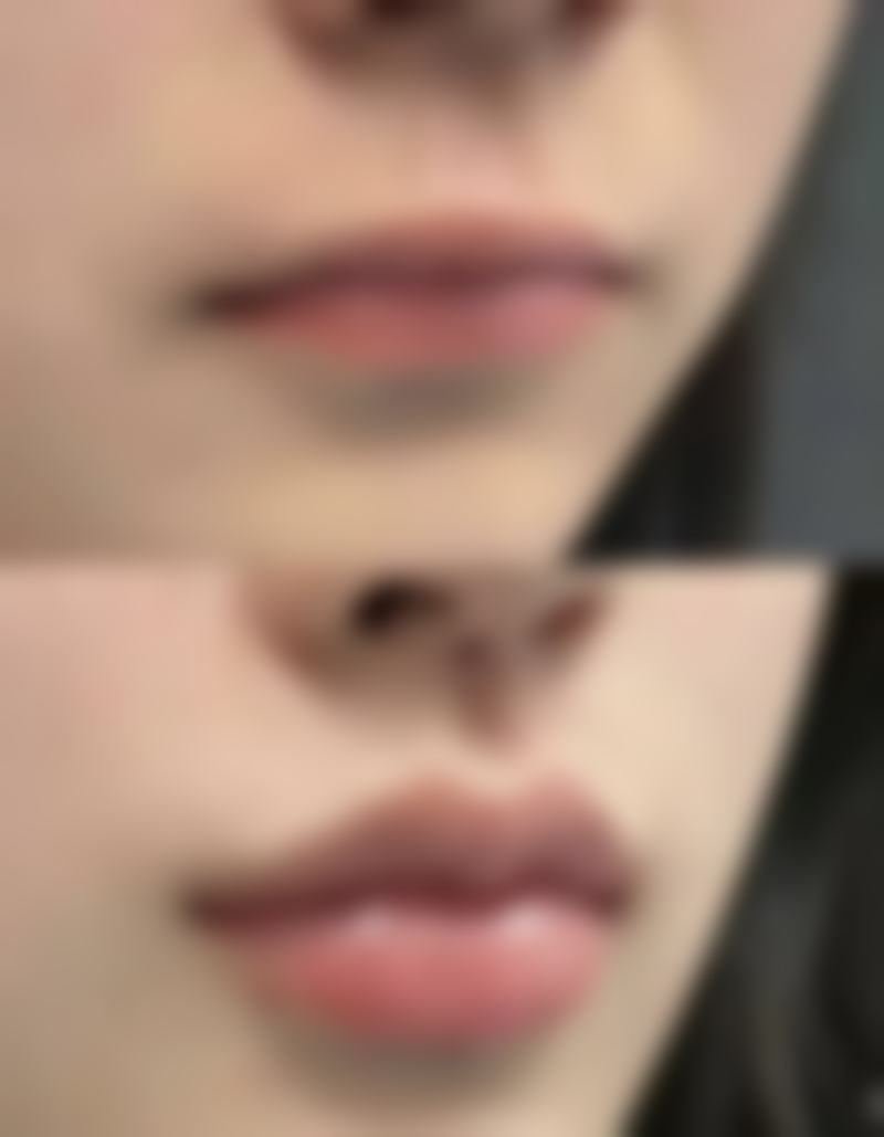 倒睫手术和双眼皮手术一样吗？了解差异，还需知晓倒睫手术要蒙眼几天 