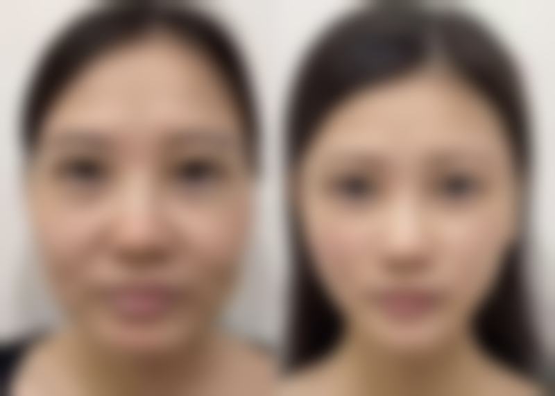 四、修复双眼皮的注意事项