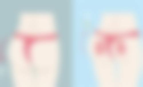 四、疤痕的黑色素沉淀激光治疗法