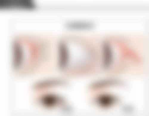 三、双眼皮是如何形成的之手术注意事项